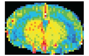 Nature Neuroscience:一種免疫蛋白可能誘發(fā)與高血壓無(wú)關(guān)的癡呆 Nature Neuroscience:一種免疫蛋白可能誘發(fā)與高血壓無(wú)關(guān)的癡呆